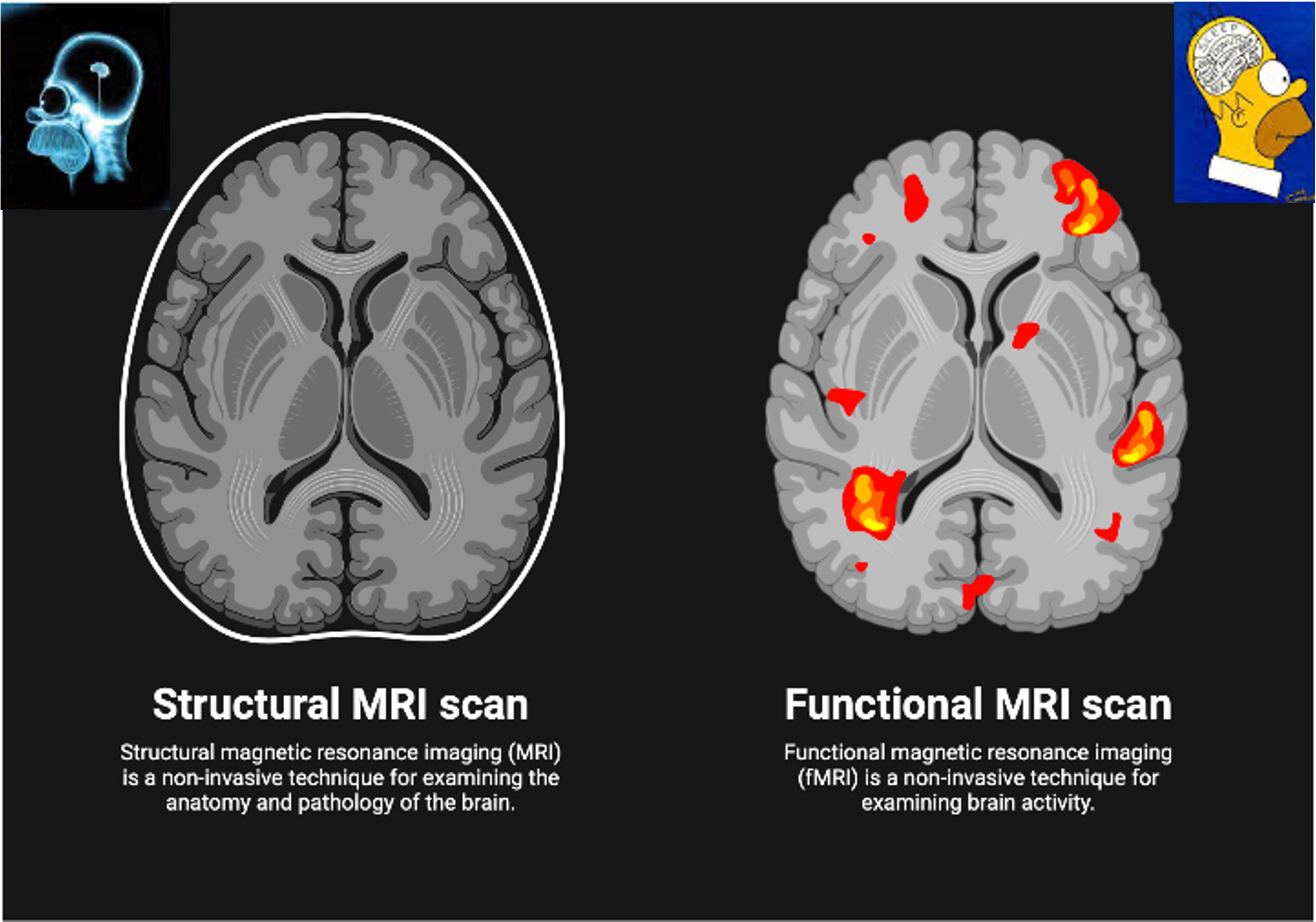 Structural MRI with fMRI overlay
